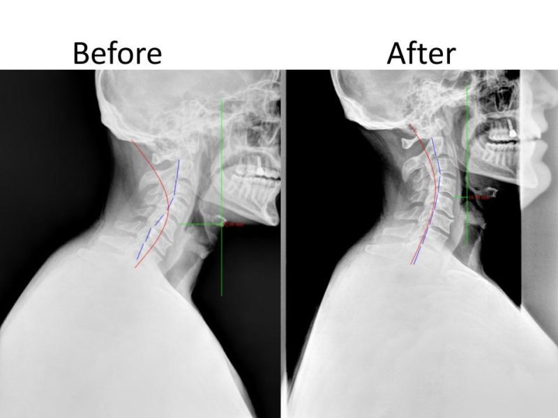 Before and After X-Rays | Champion Wellness Valrico