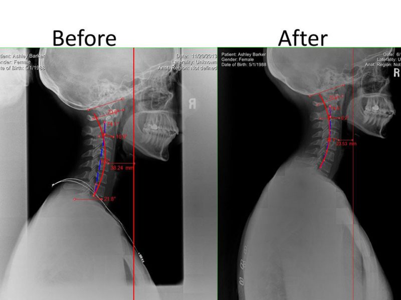 Before and After X-Rays | Champion Wellness Valrico